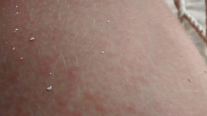 When I got Zika, this itchy red rash covered every inch of my body.